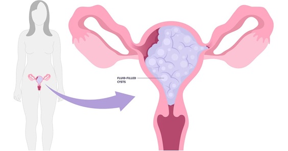Embarazo molar: qué ocurre en tu cuerpo y qué debes saber si te lo han diagnosticado